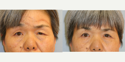 Eyelid Surgery before and after photo