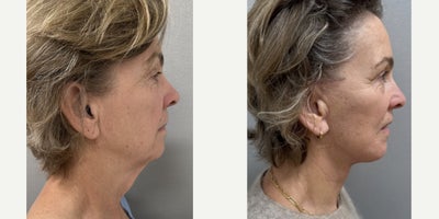 Facelift before and after photo