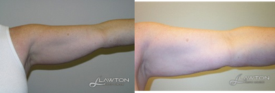 Liposculpture before and after photo