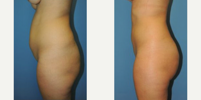 Liposuction before and after photo