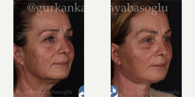 Neck Lift before and after photo