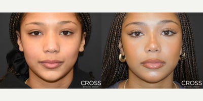 Rhinoplasty before and after photo