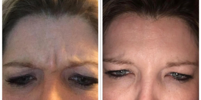 Botox before and after photo