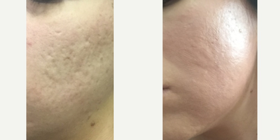 CO2 Laser before and after photo