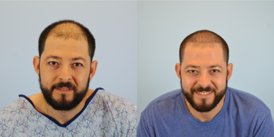 FUE Hair Transplant before and after photo