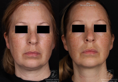 Kybella before and after photo