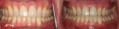 Tooth Repair before and after photo