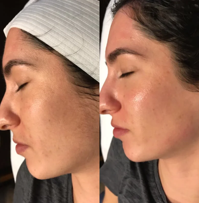HydraFacial before and after photo