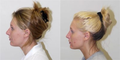 Rhinoplasty before and after photo