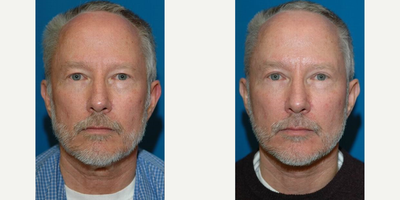 Eyelid Surgery before and after photo