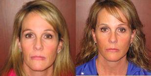 Facelift before and after photo