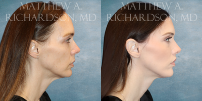 Forehead Reduction before and after photo
