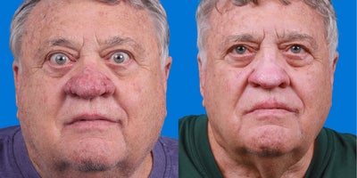 Rhinoplasty before and after photo