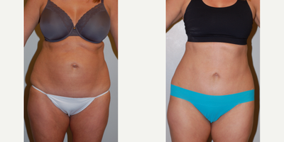 Tummy Tuck before and after photo