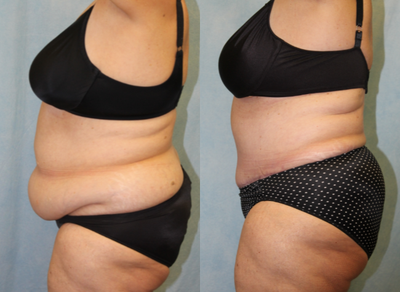 Tummy Tuck before and after photo