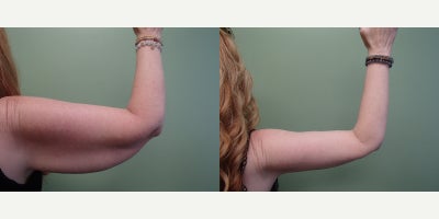 Arm Lift before and after photo