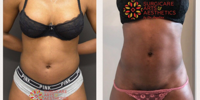 BodyTite before and after photo