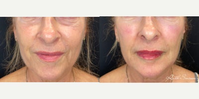 Dermal Fillers before and after photo
