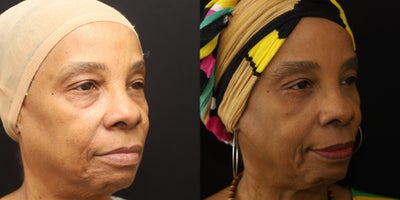 Eyelid Surgery before and after photo