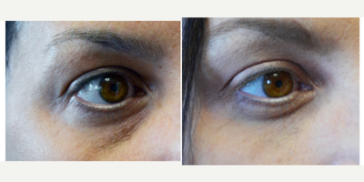 Restylane before and after photo