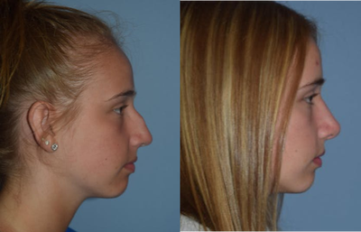 Rhinoplasty before and after photo