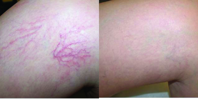 Sclerotherapy before and after photo