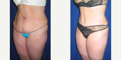 Tummy Tuck before and after photo