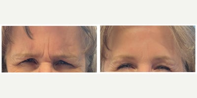 Botox before and after photo