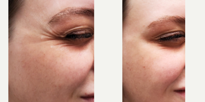 Dysport before and after photo
