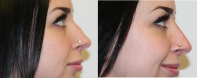 Nonsurgical Nose Job before and after photo