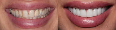 Porcelain Veneers before and after photo