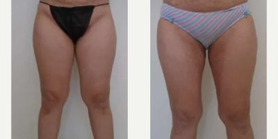 Vaser Liposuction before and after photo