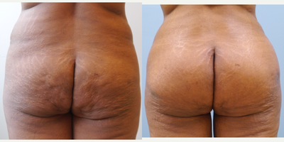 Butt Augmentation before and after photo