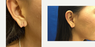 Earlobe Repair before and after photo