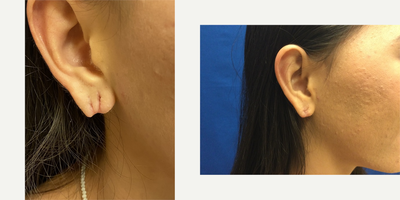 Earlobe Repair before and after photo