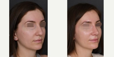 Revision Rhinoplasty before and after photo