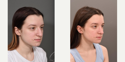 Rhinoplasty before and after photo