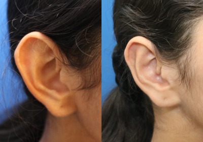 Ear Surgery before and after photo