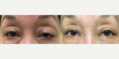 Eyelid Surgery before and after photo