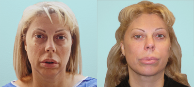 Facelift before and after photo