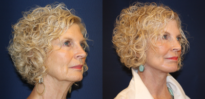 Facelift before and after photo