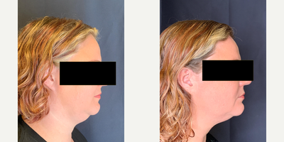 SculpSure before and after photo