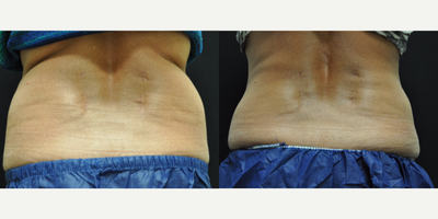 CoolSculpting before and after photo
