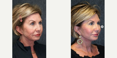 Facelift Revision before and after photo