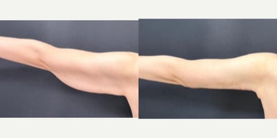 Arm Lift before and after photo