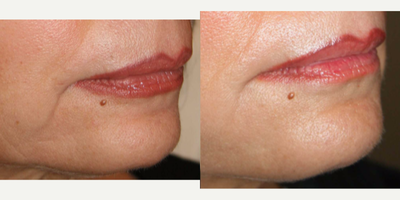 Juvederm before and after photo