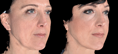 Sculptra before and after photo