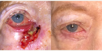 Facial Reconstructive Surgery before and after photo