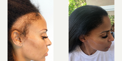 Hair Loss Treatment before and after photo