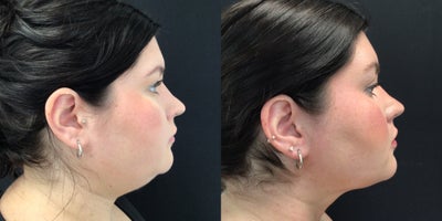 Liposculpture before and after photo